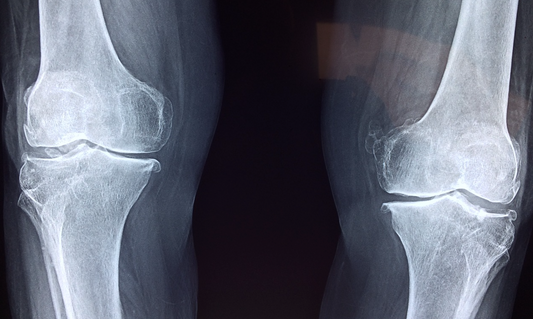 Managing Athletes with Osgood Schlatter’s Disease
